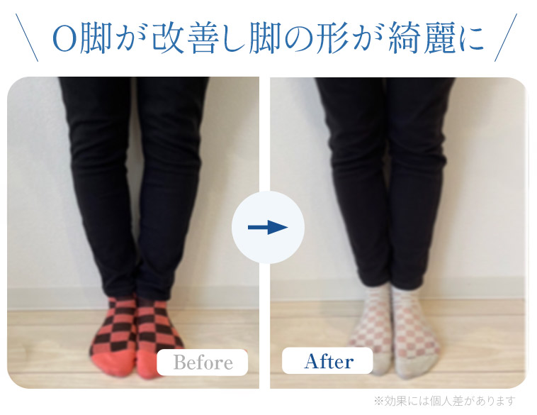 O脚矯正ビフォアフター